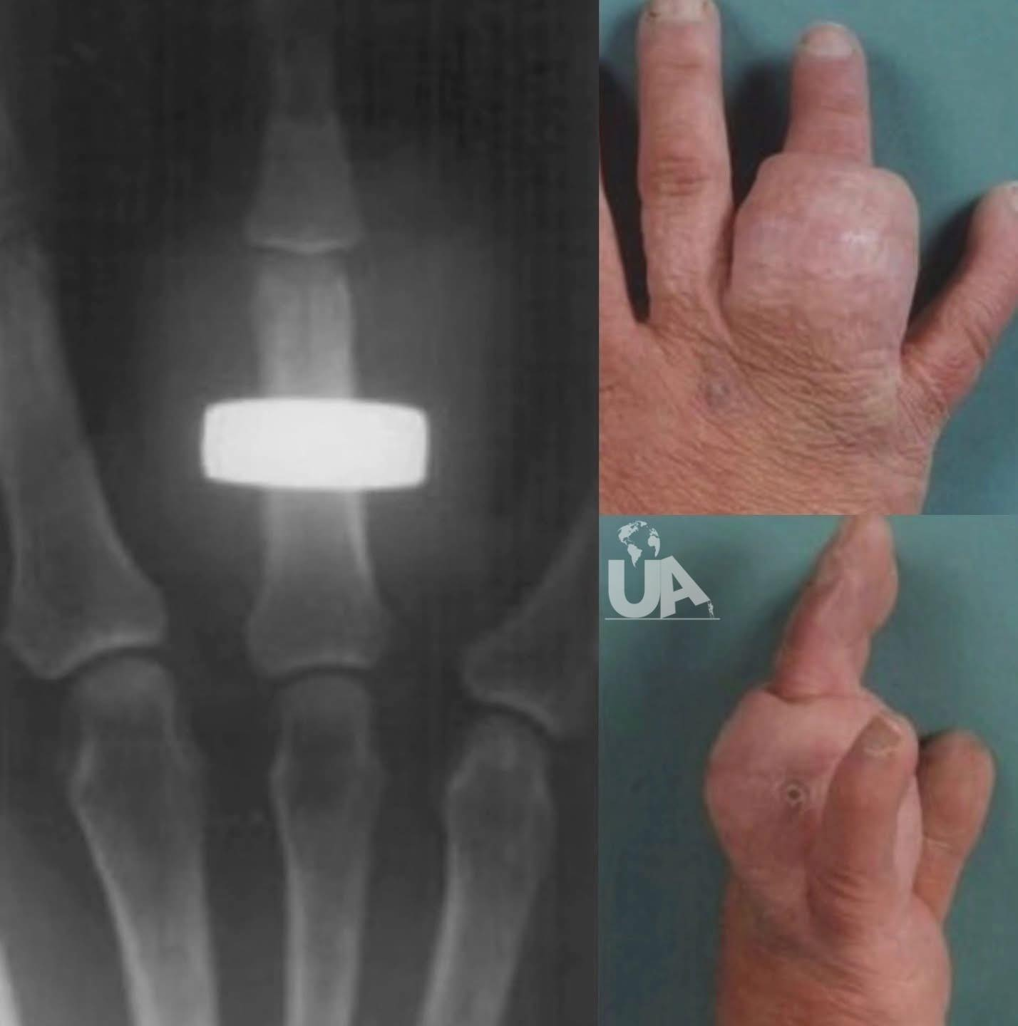 ¡Se le “comió” el dedo el anillo!💍